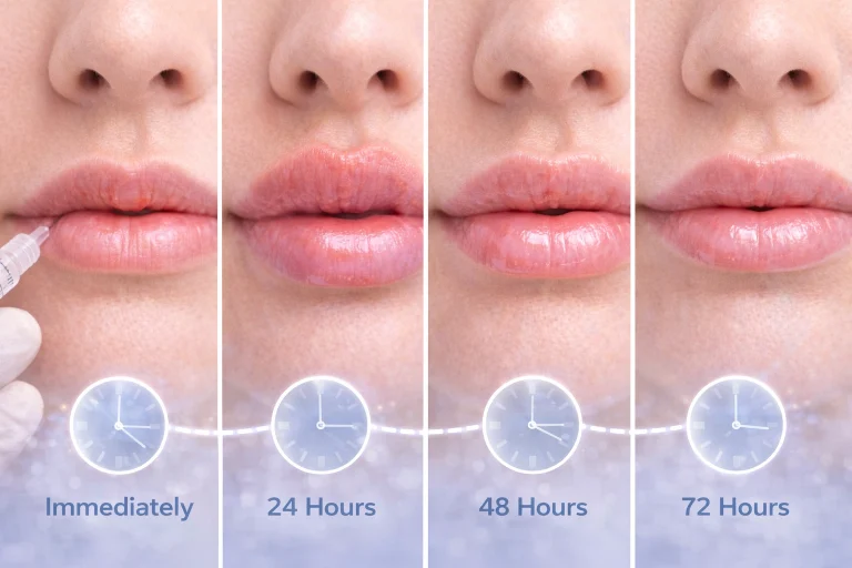 What Are the Lip Filler Swelling Stages?