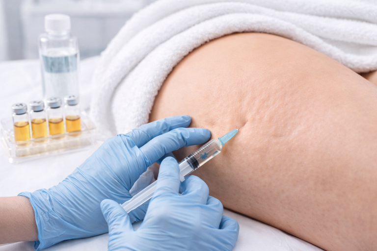 What is Treatment Mesotherapy for Cellulite?