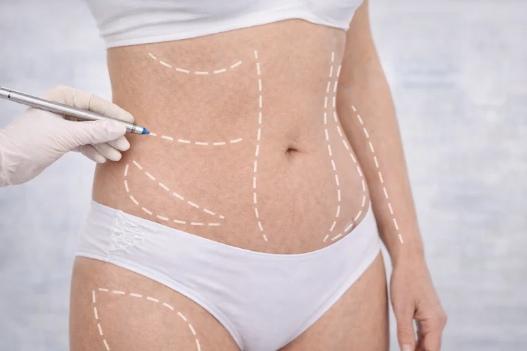 What is Body Contouring Surgery?