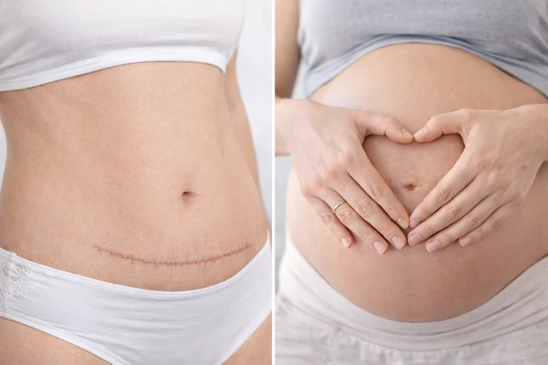 Can You Get Pregnant After a Tummy Tuck?