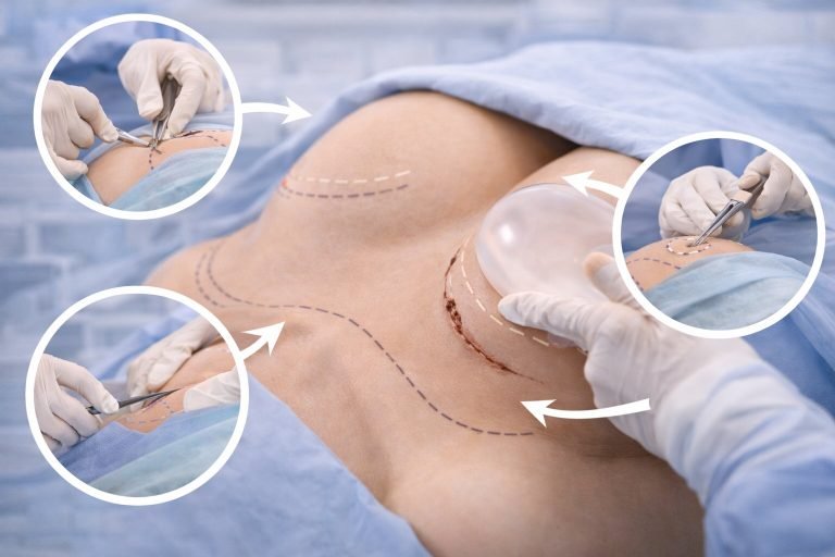 How to Do Breast Enlargement Surgery?