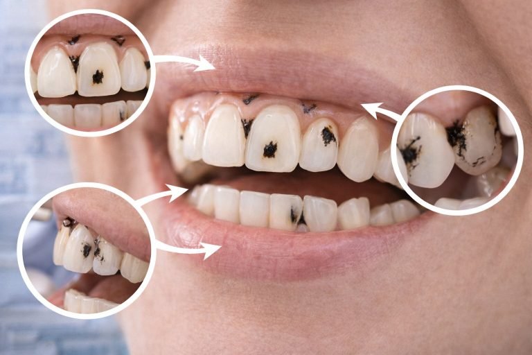 What Are Black Stains on Teeth?