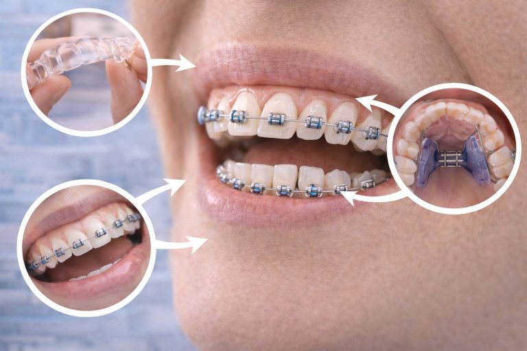 What is an Orthodontic Appliance?